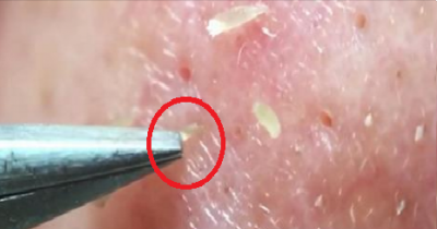 Crazy Guy Pulls Out Nose Blackheads For Entire 8 Minutes Without Stopping