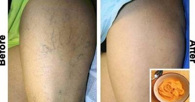 The Most Effective Natural Treatment For Varicose Veins!