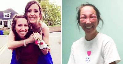 Girl&rsquo;s Face Swells After Getting Poison Ivy in Her Eyes