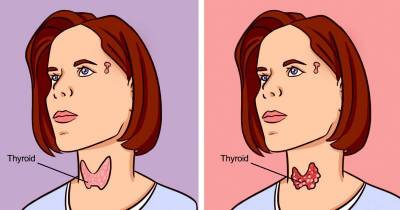 Hypothyroidism vs. Hyperthyroidism