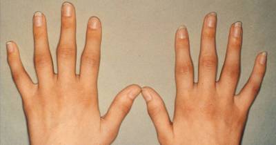 How To Naturally Ease Painful Arthritis Symptoms