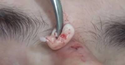 Doctor Removes Huge Cyst From Man's Nose By Burning Away Skin With Laser In Stomach-churning Video