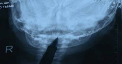 Doctors Remove 4cm Sewing Needle From Young Baby's Throat In Graphic Video