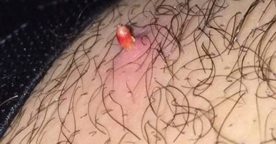Pimples That Will Force You To Dare And Pop Them Out Without Dr Pimple Popper's Help