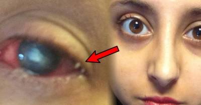 Teenager Kept Awake For Week To Stop Parasite Burrowing Into Eyeball