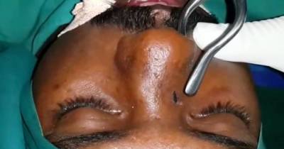 Graphic Video Shows Stomach-Churning Moment Fractured Nose Is Realigned