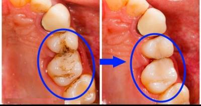 Gargle With These Odd Things And See What Happens To Your Teeth