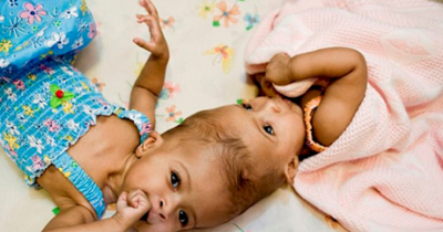 5 Twins Separated At Birth And How They're Doing Now