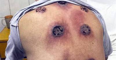 Man Left With SEVEN Horrific Holes In His Back After Botched Cupping Procedure