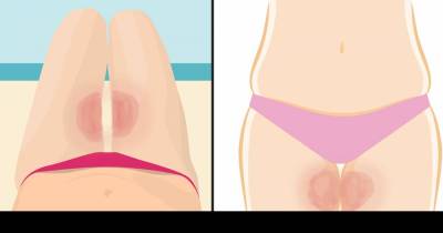 This Is The Simplest Way To Stop Your Thighs From Getting Chafed This Summer.
