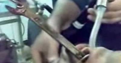 These Doctors Managed To Pull An Entire Wrench Out Of A Patient's Throat