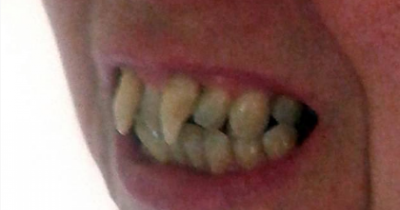 This 49-Year-Old Woman Had A Rare Gum Disease That Turned Her Teeth Into Vampire Fangs
