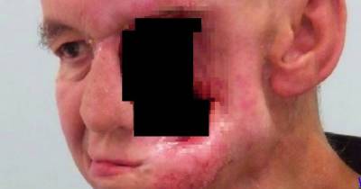 This Man Lost His Face To Nose Cancer, How He Gets His Face & Life Back Will Give Hope To Others