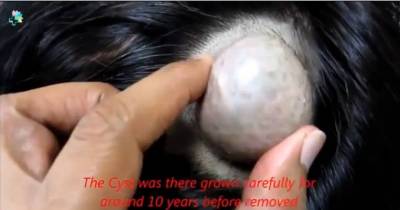 Sickening Footage Shows Giant Cyst Growing Out Out Of Woman's Head Being Cut Off And Dissected