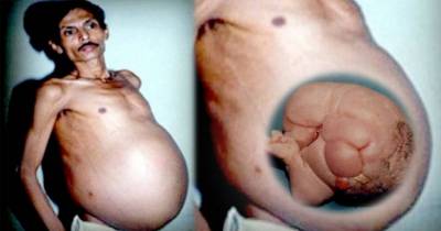 Weird Things Found Growing Inside People