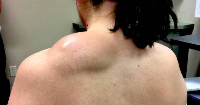 Dr. Pimple Popper Takes On An Enormous Lipoma On A Patient's Back. Her Biggest One Yet!