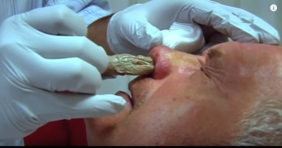 Removal Of Tampon From Man's Nose Leaves Everyone In Shock!