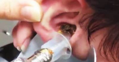 Man Gets Nasty Ear Wax Build Up Pumped Out