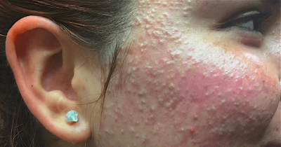 Dr. Pimple Popper's Latest Patient Isn't A Sprint, She's A Marathon (of Whiteheads).