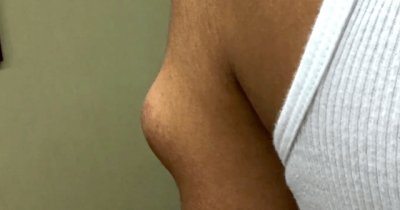 Even Dr. Pimple Popper Didn't Know What This Huge Lump Was Until It Squirted All Over Her.