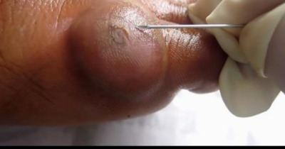When This Man Poked The Massive Blister, He Didn&rsquo;t Know What Would Burst Out At 0:57.