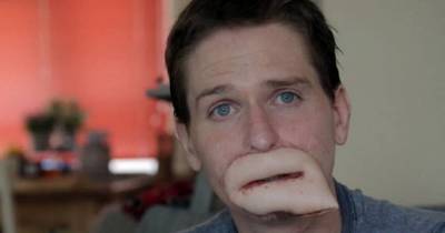 This Dad Lost His Limbs And Part Of His Face To A Flesh-Eating Bug