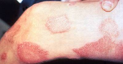 This Strange Disease Is Making A Comeback In America. Avoid This Animal At All Costs