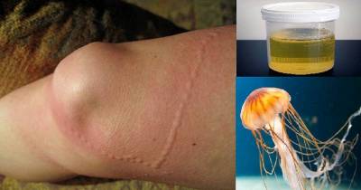 Here&rsquo;s What Actually Happens When You Pee On A Jellyfish Sting