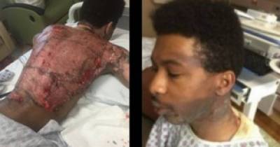 Father Pours Boiling Water On Son After Catching Him Alone With His Boyfriend
