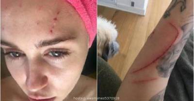 Shocking: Miley Cyrus Has Brutal Cuts On Her Body. Who Is Behind This? UNBELIEVABLE!