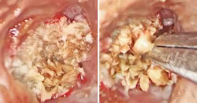 Man Gets Impacted Ear Wax Removed Manually
