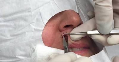 Woman Had A Lump Over Her Lip, Could Never Imagine What The Doctor Found Inside
