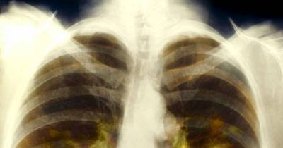 Breakthrough Lung Cancer Drug Could Detect It Early And Stop The Deadly Disease From Spreading Around The Body