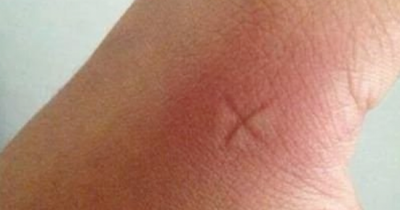 Here&rsquo;s What Actually Gets Mosquito Bites To Stop Itching