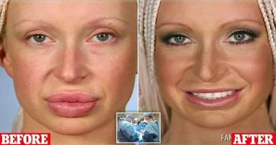 She Injected Sheep Fat Into Her Lips, What Followed Next Is Horrifying!