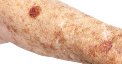 Get Rid Of Age Spots With Natural Household Ingredients