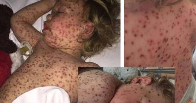 Toddler Is Hospitalized With The Worst Chickenpox These Doctors Have Ever Seen