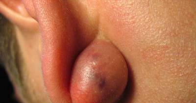 Goodbye, Cyst! Get Rid Of Cysts Naturally With These Simple Tricks