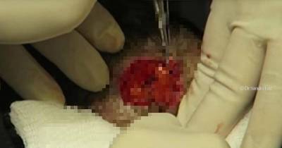 Dr Pimple Popper Cuts Out Gigantic Growth From Woman's Neck In Grotesque Video