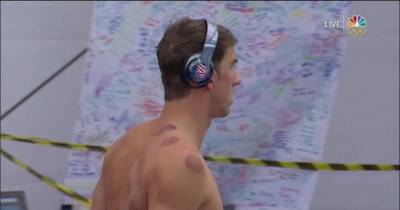 Michael Phelps Has These Round Bruises All Over His Body