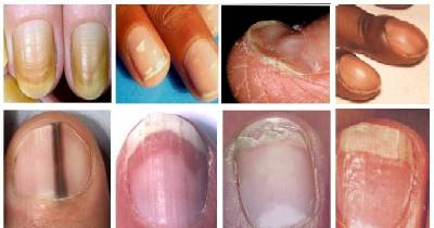 12 Changes In Your Fingernails That Could Signal Other Problems