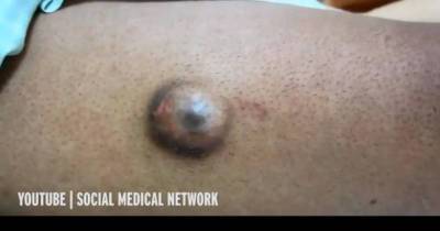 Disgusting Monster Cyst Growing Out Of Man's Thigh Looks Just Like An Eyeball