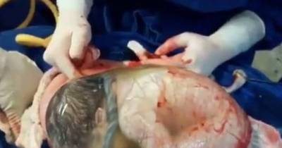 Watch The Incredibly Rare Moment A Baby Is Born Inside The Amniotic Sac