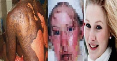 You Might Not Have Heard About Toxic Epidermal Necrolysis But It's No Joke