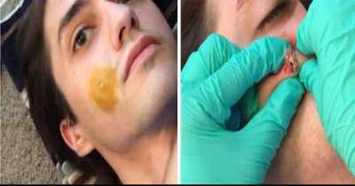 Women Pops Never Ending Cyst On BoyFriend's Face