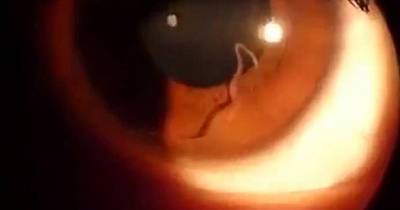 This Woman Has A Live Worm Squirming Around In Her Eyeball
