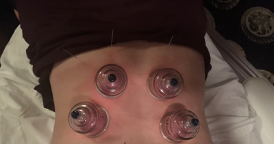 I Tried Cupping & Lived To Tell The Tale