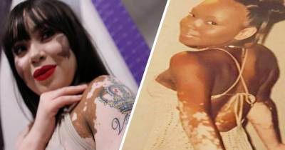 Woman With Vitiligo Beats Her Bullies