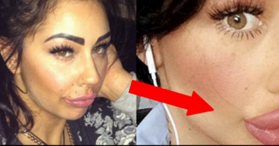 Mom Spent Thousands Of Dollars On Lip Fillers To Achieve Her Dream "Trout Pout", Now Wants More