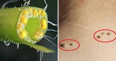 How To Get Rid Of Warts Forever